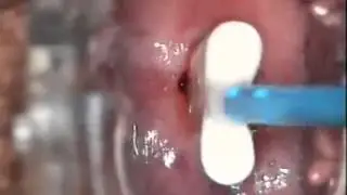 Colposcopy Exam [+18]