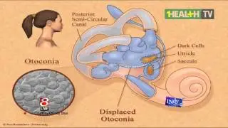 Tanda Tanda Pengidap Vertigo - dr. Sesanti Hayuning Tyas,SpTHT-KL