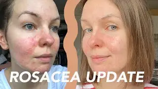 SKIN UPDATE: LIFE AFTER ROSACEA