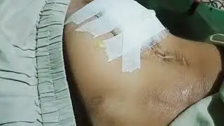 sciatic nerve injection treatment