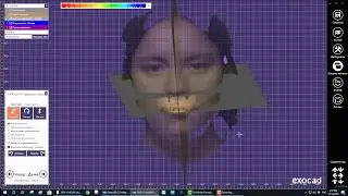 DOF SNAP. Протокол сканирования и переноса в Exocad