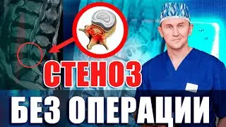 КАК ЛЕЧИТЬ СТЕНОЗ БЕЗ ОПЕРАЦИИ! НЕЙРОХИРУРГ
