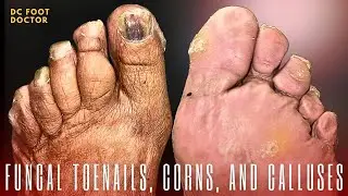 Fungal Toenails, Corns, and Calluses:  Diabetic Foot Care