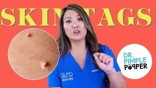 Ask Dr. Pimple Popper | Skin Tags & Acne Scars