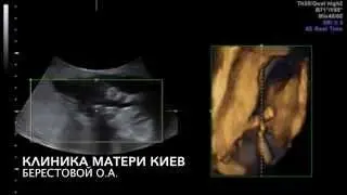 ЭТО ВИДНО НА УЗИ! Срок беременности 15   16 недель  Плод 