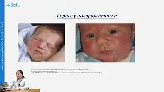 Герпетическая инфекция у детей
