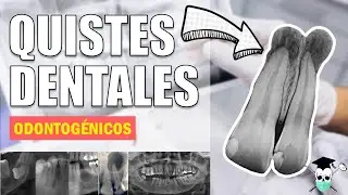 QUISTES ODONTOGÉNICOS *¿Cuál es su origen?, Generalidades y Clasificación Actual*