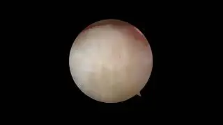 Bone Spur Removal for Treatment of Big Toe/Hallux Arthritis (Cheilectomy)