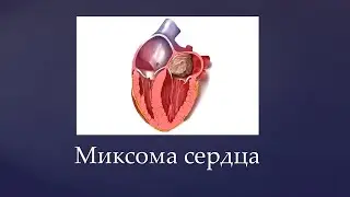 Миксома сердца