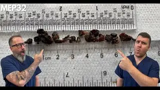 REALLY DIFFICULT DRY DEEP EAR WAX PLUG REMOVAL - MEP32