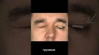 Лечение паралитического лагофтальма.