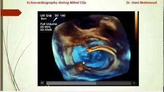 Echocardiography during Mitral Clip