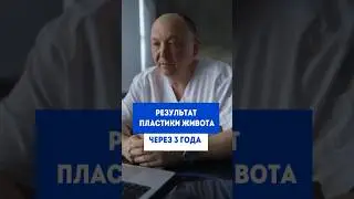 Результат пластики живота через 3 года