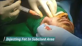 Acne Scar Subcision | Acne Treatment, Scar Removal, Cosmetic Surgeon in Pal, Adajan, Surat