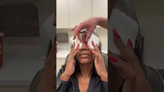 Results of Bridge Augmentation | Anthony Bared, MD, FACS Miami, FL