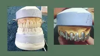 Q&A sobre estratificación de porcelana sobre metal con Ceramax