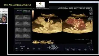 KANKER OVARIUM CURIGA KEGANASAN (Dr Wiku Andonotopo)