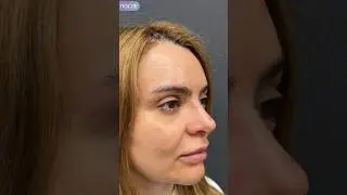 Эндоскопический лифтинг лба и висков