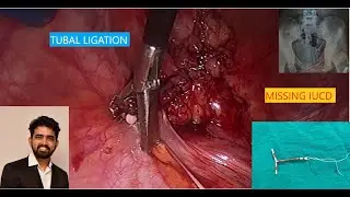 MISSING IUCD (COPPER-T) AND TUBAL LIGATION (TL) LAPAROSCOPY