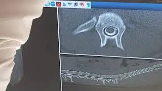 Méningo myélite epilepsie Kotetsu