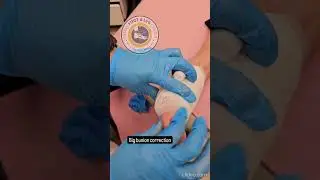 Bunion Banisher: Dr. Kevin Lam's Pioneering Methods | Lam Bunionectomy