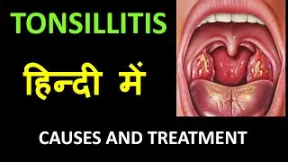 Tonsillitis - Infection of Tonsils - IN HINDI
