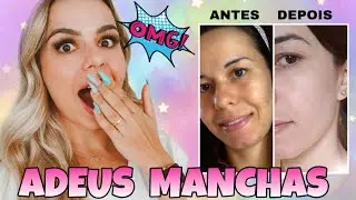 COMO CLAREAR MANCHAS NO ROSTO DE ACNE, SOL E MELASMA - (ANTES E DEPOIS)