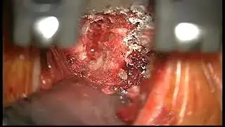 Anterior Cervical Discectomy
