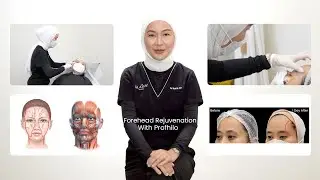 Forehead Rejuvenation With Profhilo