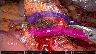 Robotic left hemicolectomy: Two-surgeon dual-console technique