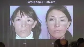 11 Ныжник ЛМ Применение стволовых клеток на основе липоаспирата для лечения свищей и дефектов мягких
