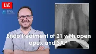 🔴  Endo treatment of 21 with open apex and SAP
