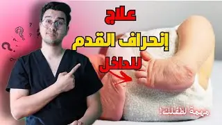 ‏انحراف القدم للداخل | علاج انحراف القدم للداخل عند الأطفال - Club Foot