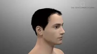 So funktioniert eine Haartransplantation