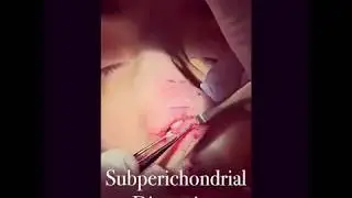 Subperichondrial Dissection (Rhinoplasty) Time Lapse | Cangello Plastic Surgery