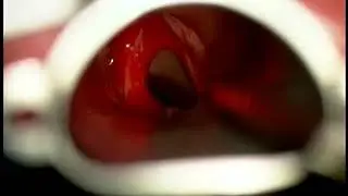vokal kord hemanjiomu