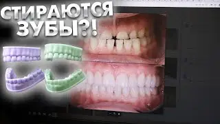 Повышенная стираемость зубов вследствие бруксизма