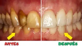 Discover HOW TO REMOVE YELLOW STAINS from TEETH at Home