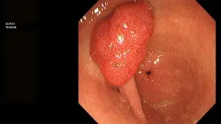 LARGE PEDUNCULATED GASTRIC  POLYP