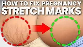 HOW TO PREVENT/GET RID OF STRETCH MARKS DURING PREGNANCY