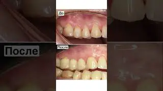 Закрываем оголившиеся корни зубов