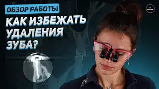Как избежать удаления зуба? Обзор работы.