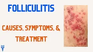FOLLICULITIS Causes, Symptoms, & Treatments