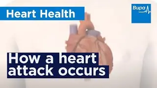 How a heart attack occurs | Bupa Health