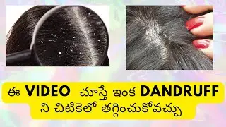 How to remove Dandruff permanently