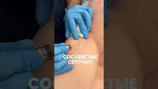 Сосудистые сеточки на ногах. Что с ними делать? #ташкент