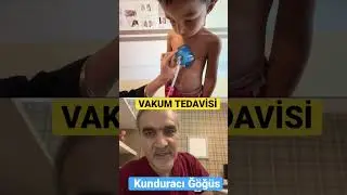 KUNDURACI GÖĞÜS HASTALIĞINDA AMELİYATSIZ TEDAVİ: VAKUM BELL KULLANIMI