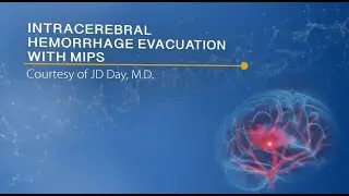 Intracerebral Hemorrhage Evacuation with MIPS, JD Day MD