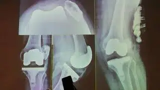 Hinged TKR