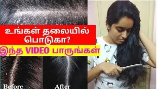 #7.பொடுகை போக்க இந்த இரண்டையும் தவறாமல் செய்யுங்கள்!!!DANDRUFF SOLUTION
